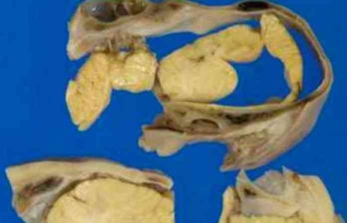 tumor