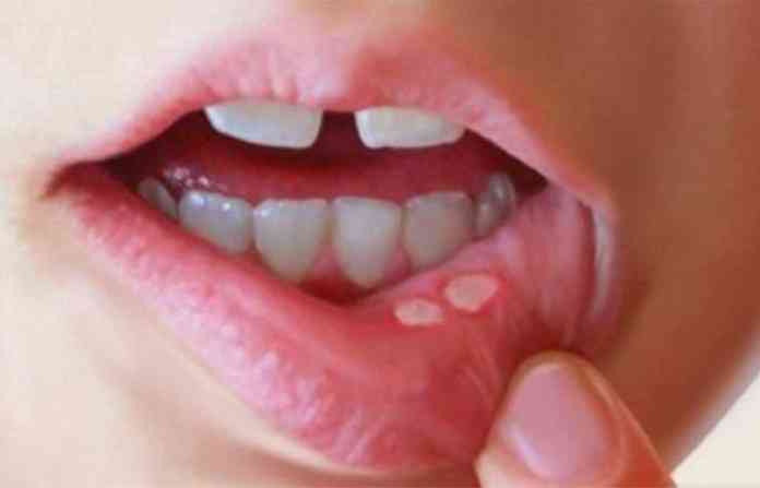 ulcer