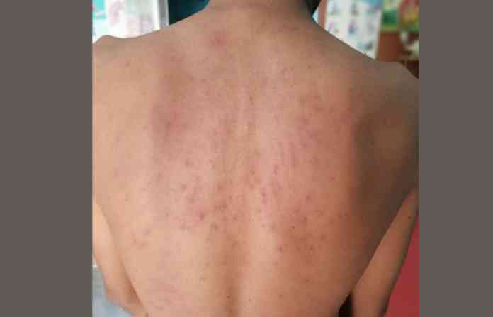 skin-desease