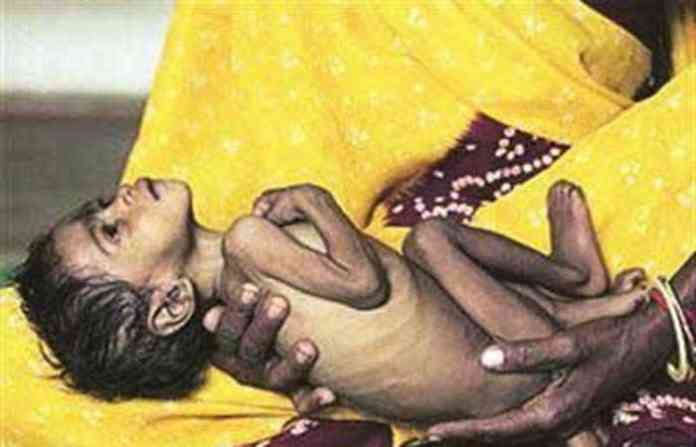 malnutrition