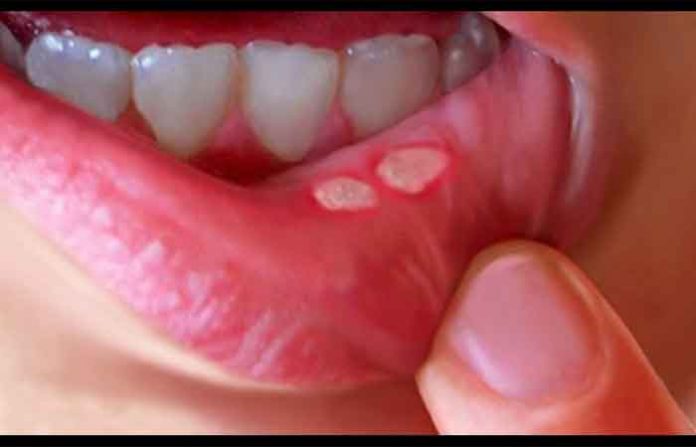 mouth-ulcer