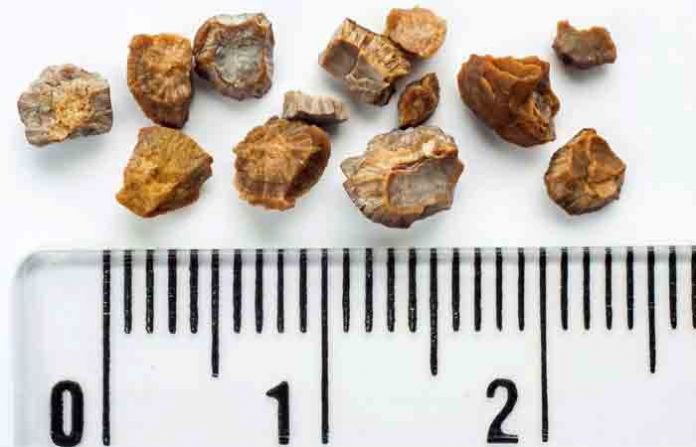 kidney stone