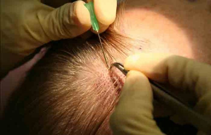 hair-transplant