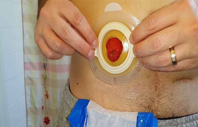 ostomy