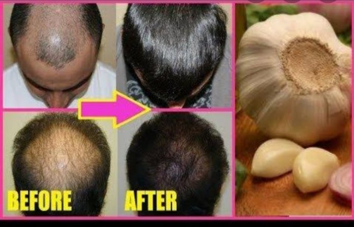 garlic-hairfall_700x450