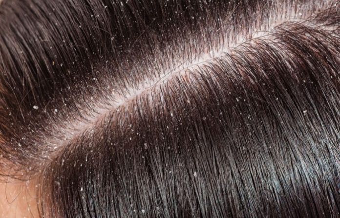 dandruff