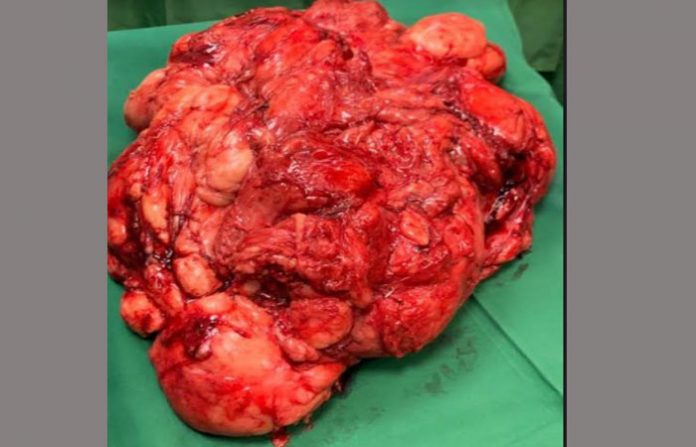 tumor
