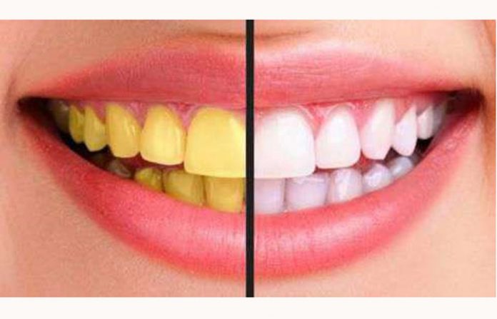 very-yellow-teeth-now-shine-like-diamonds-adopt-these-lines_248923