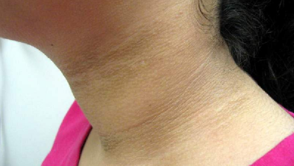 0home-remedies-to-clean-black-neck