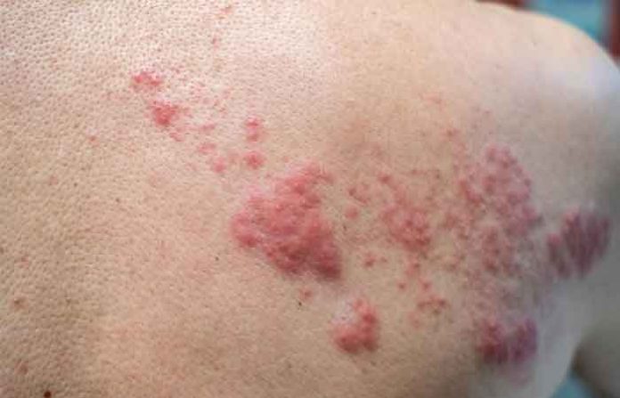 nagin-disease