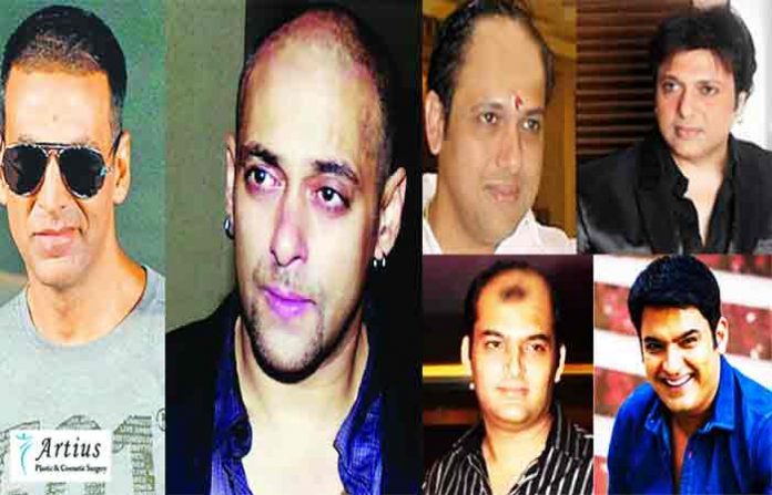 bollywood-actors-hair-loss