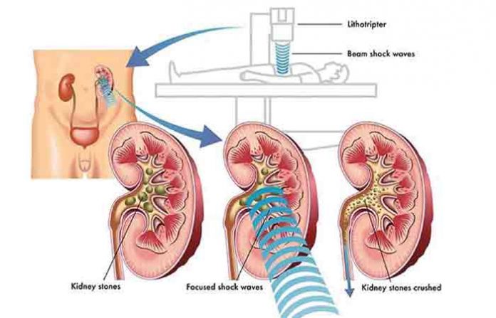 extracorporeal-shock-wave-l