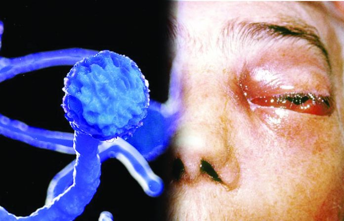 mucormycosis-22