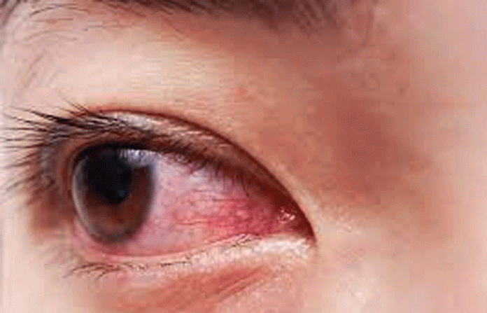 red-eye