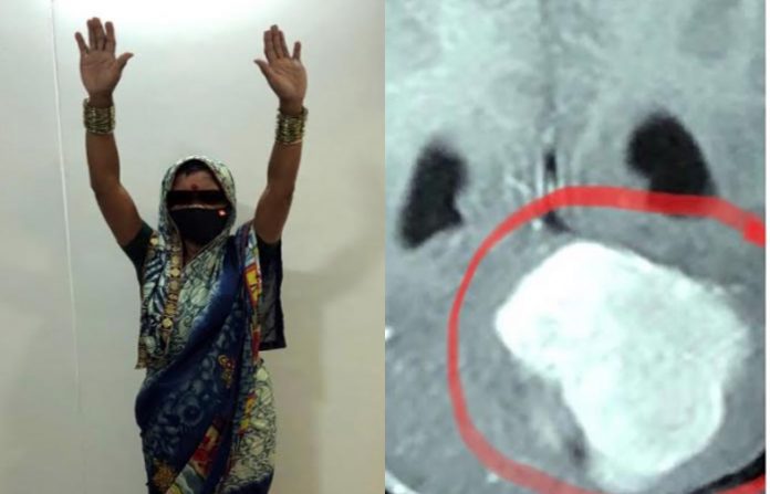 beed-tumor