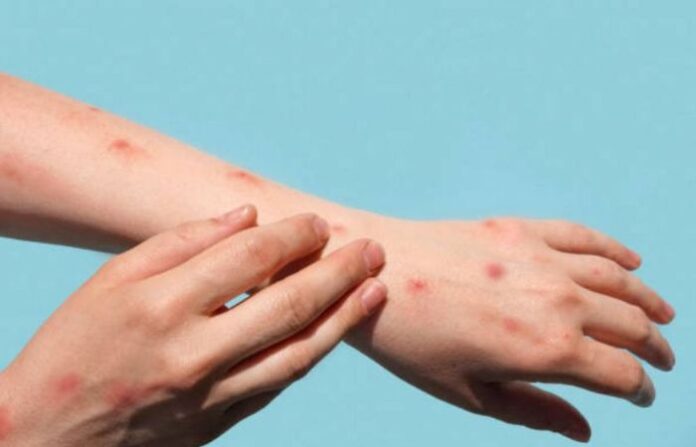 monkey pox1
