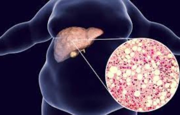 nafld