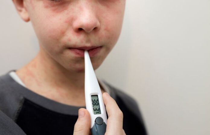 measles generic image
