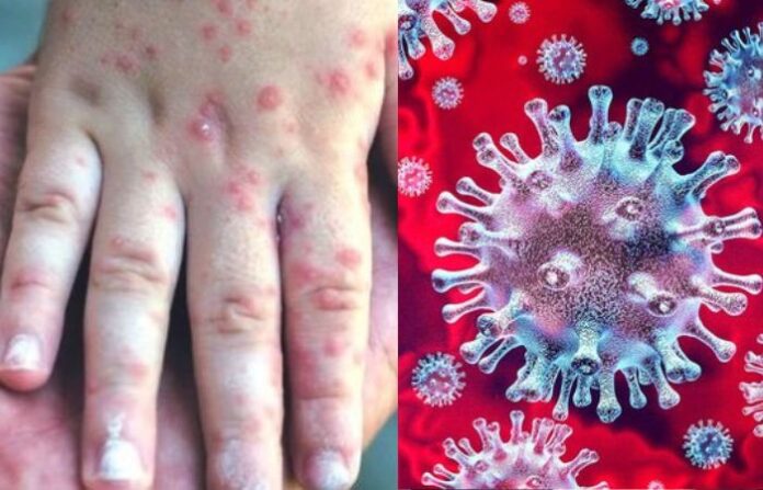 measles virus mumbai