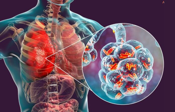 TB Tuberculosis
