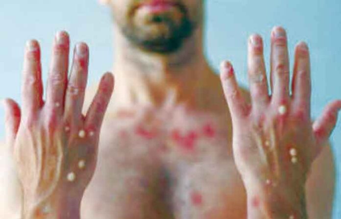 monkeypox