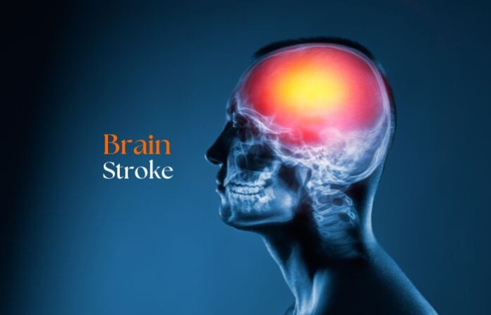 brain stroke