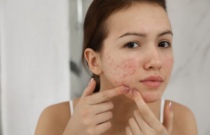 Pimples (1)