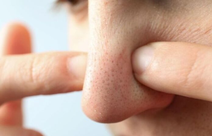 blackheads (6)