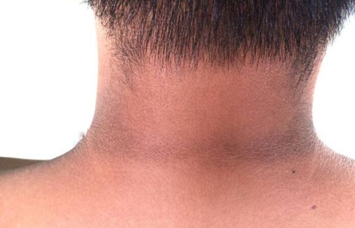 neck black spot