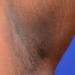 अंडरआर्म, मानेवरील काळेपणा घालवण्यासाठी करा हे खात्रीशीर उपाय, वाचा