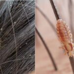 केसांमधील उवा होतील चुटकीसरशी गायब, वापरा ‘या’ महत्त्वाच्या टिप्स