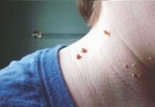 चामखीळ हटवायची असेल तर… हे करून पहा