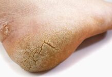 हिवाळ्यात टाचांना भेगा पडल्यास त्यावर कोणते घरगुती उपाय कराल, वाचा