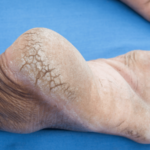 टाचांना भेगा पडल्यास… हे करून पहा