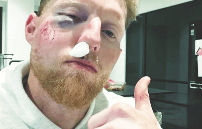 ben stokes facial injury england test captain hit by ball during practice session