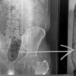 तरुणाला गुदाशयात असह्य वेदना होत होत्या, एक्स रे पाहून डॉक्टरही अवाक्