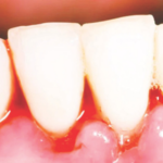 असं झालं तर… ब्रश करताना हिरड्यांमधून वारंवार रक्त येतेय