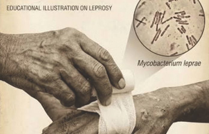 Leprosy