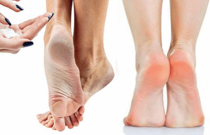 Home Remedies for Cracked Heels